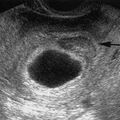 subchorionic_hematoma_4.jpg