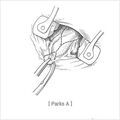 submucosal_hemorrhoidectomy01.jpg