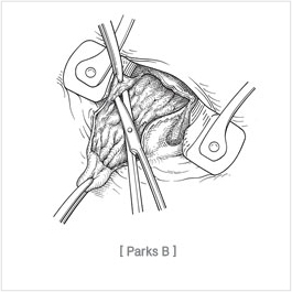 submucosal_hemorrhoidectomy02.jpg