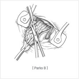 submucosal_hemorrhoidectomy02.jpg