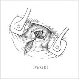 submucosal_hemorrhoidectomy04.jpg