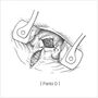 submucosal_hemorrhoidectomy04.jpg
