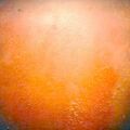 sunburn2-965.jpg