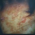syphilid12.jpg