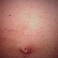 syringoma_eruptive2000-246.jpg