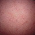 syringoma_eruptive2000-247.jpg