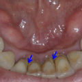 teeth_1017021116.png