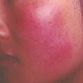 telangiectasia8-912.jpg