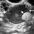 teratoma_0401.png