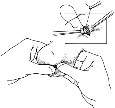 A 0.5 cm transverse incision over upper lateral or medial aspect of testis. Hemostats hold open edges of tunica vaginalis.