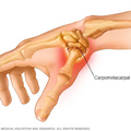 thumb_arthritis_4428.png