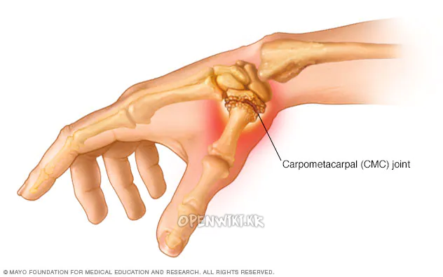 thumb_arthritis_4428.png
