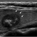 thyroid_ultrasonography_0010.png