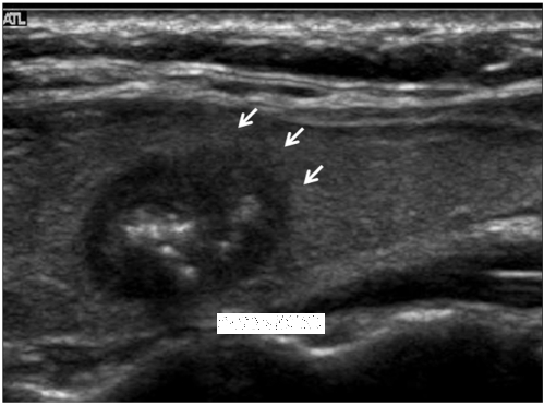 thyroid_ultrasonography_0010.png