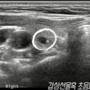 thyroid_ultrasonography_1343.png