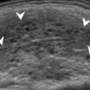 thyroid_ultrasonography_1429.png