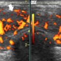 thyroid_ultrasonography_1525.png
