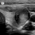thyroid_ultrasonography_2034.png