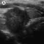 thyroid_ultrasonography_2533.png