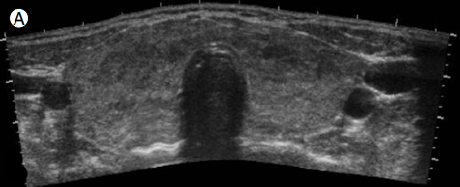 thyroid_ultrasonography_4123.png