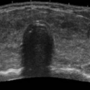 thyroid_ultrasonography_4123.png