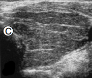 thyroid_ultrasonography_4129.png