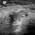 thyroid_ultrasonography_4233.png