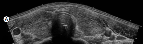 thyroid_ultrasonography_4828.png