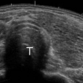 thyroid_ultrasonography_4828.png