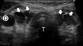 thyroid_ultrasonography_5629.png