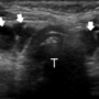 thyroid_ultrasonography_5629.png