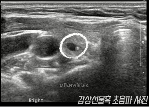 thyroid_ultrasonography_5741.png