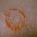 tinea4.jpg