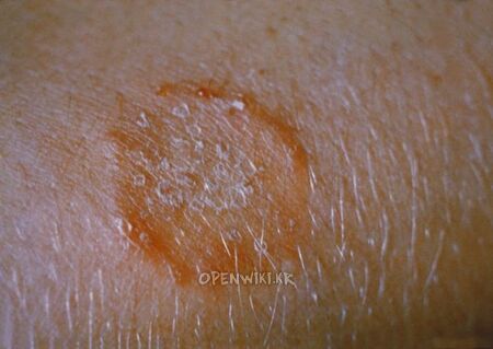 tinea4.jpg