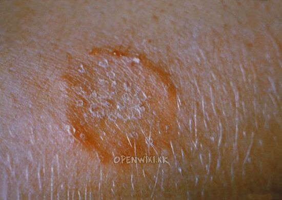 tinea4.jpg