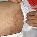 tinea_cruris.jpg