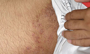 tinea_cruris.jpg