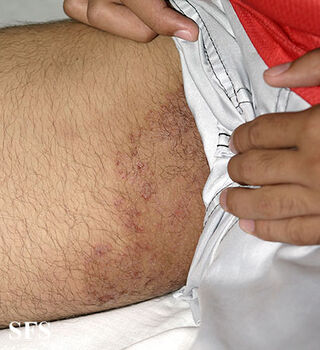 tinea_cruris.jpg