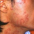 tinea478.jpg