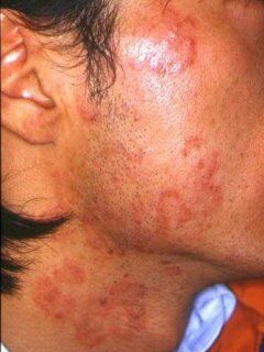tinea478.jpg