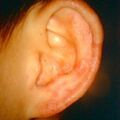 tinea_ear9-756.jpg