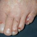 tinea_vesicular010507-1.jpg