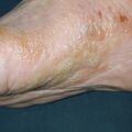 tinea_vesicular010507-3.jpg