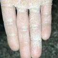 tineamanus010227-2.jpg
