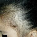 tractionalopecia020123-1.jpg