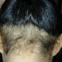 tractionalopecia020123-2.jpg