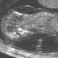 trisomy21nt_thickness.jpg