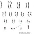 trisomy_21.jpg