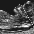 trisomy_21_absent_nasal_bone_ossification.jpg