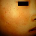 tuberculid_papulonecrotic2-1136.jpg